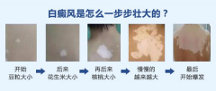 白癜风有哪些基本症状_宁波哪家医院能治白癜风