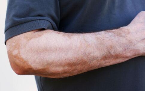 宁波华仁白斑医院分析治手臂上白斑的方法