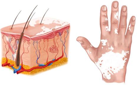 宁波宝宝身上有白斑原因 手部为什么会有白斑